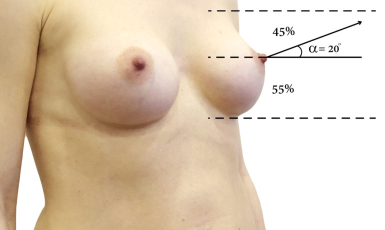 Первичная увеличивающая пластика груди. Хирургические каноны её выполнения.