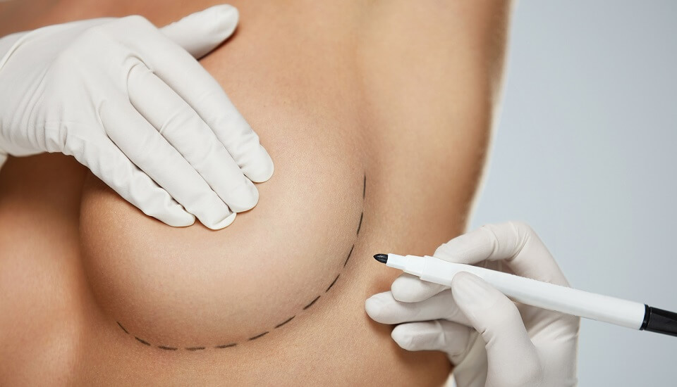 Повторная маммопластика. Причины и риски повторной операции по коррекции груди.